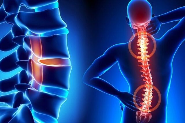 durere la nivelul coloanei vertebrale cu osteocondroză lombară