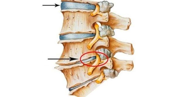 disc spinal sănătos și deteriorat cu osteocondroză cervicală