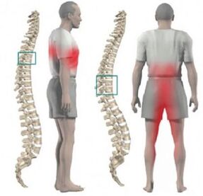 afectarea coloanei vertebrale și durerea în osteocondroza toracică