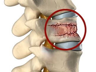 Cauzele durerilor de spate pot fi boli ale coloanei vertebrale și ale discurilor intervertebrale. 