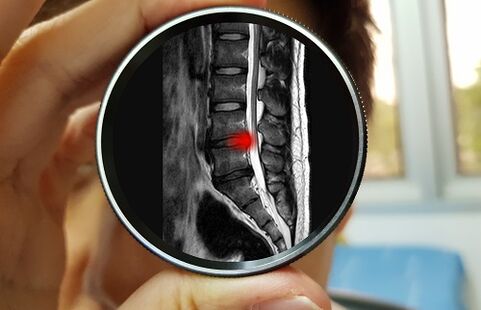 Consecința ignorării durerilor de spate poate fi o hernie de disc. 