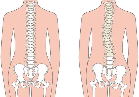 Dureri de spate cauzate de deformarea coloanei vertebrale, cum ar fi scolioza