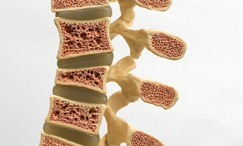 Osteoporoza este una dintre cauzele durerilor de spate