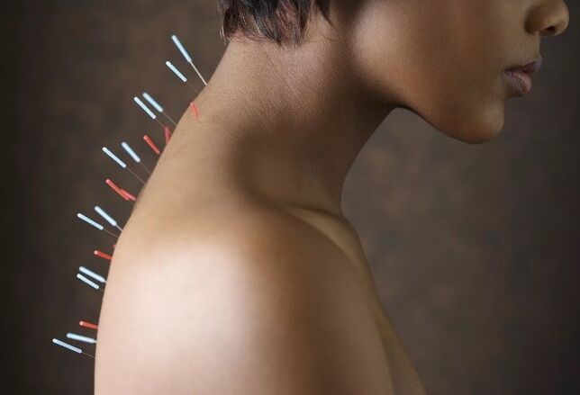 Acupunctură