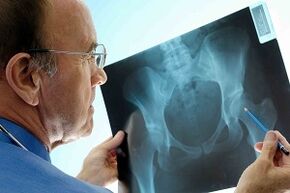 Arthroza articulației șoldului pe x -ray