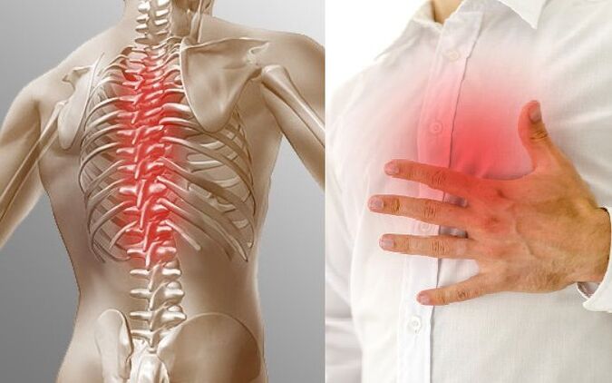 Osteochondroză toracică și dureri toracice