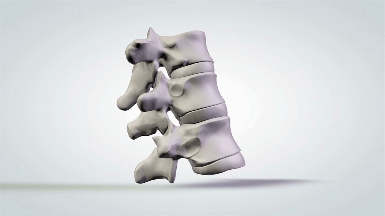afectarea coloanei vertebrale din cauza osteocondrozei cervicale