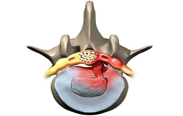 vertebra afectată de osteocondroză