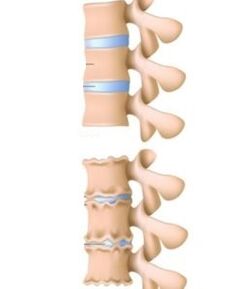 cauzele osteocondrozei
