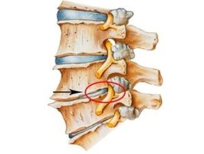 semne și simptome de osteocondroză